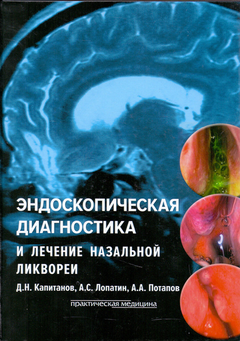 Эндоскопическая диагностика и лечение назальной ликвореи. Д.Н. Капитанов, А.С. Лопатин, А.А. Потапов. 