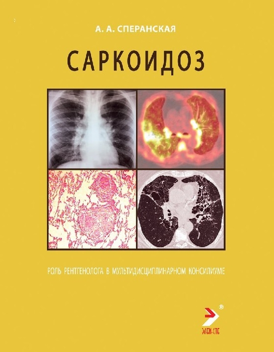 Саркоидоз. Роль рентгенолога в мультидисциплинарном консилиуме. Сперанская. 2025 г.