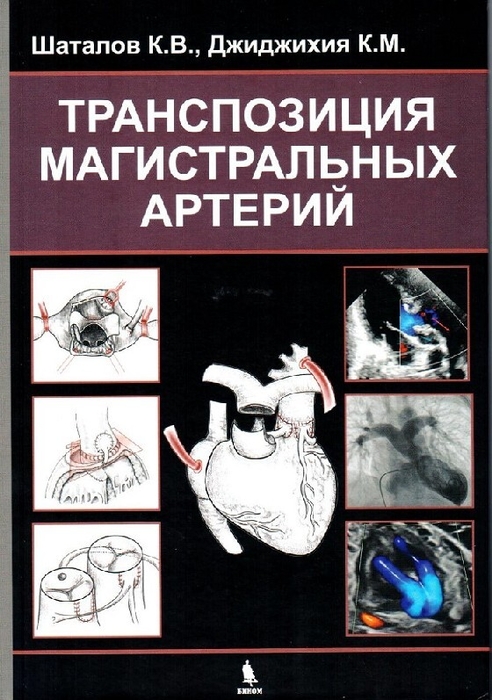 Транспозиция магистральных артерий Шаталов. 2026 г.