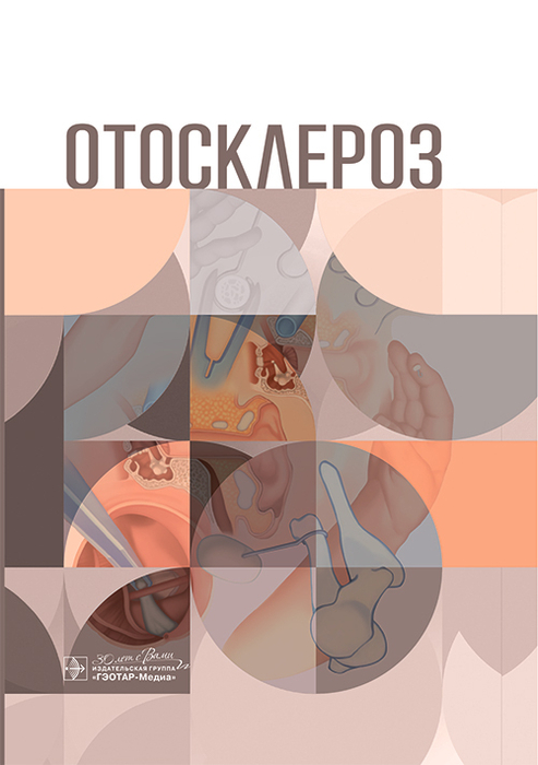 Отосклероз. Крюков. 2025 г.