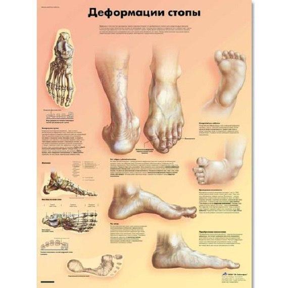  Медицинский плакат "Деформации стопы"