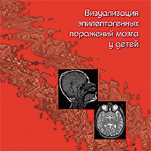 Визуализация эпилептогенных поражений мозга у детей. CD-диск. Под ред. Алиханова А.А.